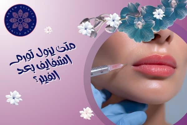 متى يزول تورم الشفايف بعد الفيلر؟