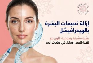 ازالة تصبغات البشرة هيدروفيشيل