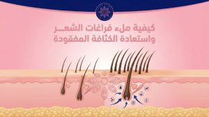 كيفية ملئ فراغات الشعر واستعادة الكثافة المفقود