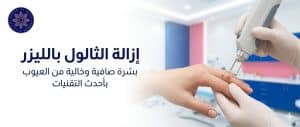 ـ إزالة الثالول بالليزر