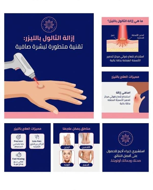 ـ إزالة الثالول بالليزر